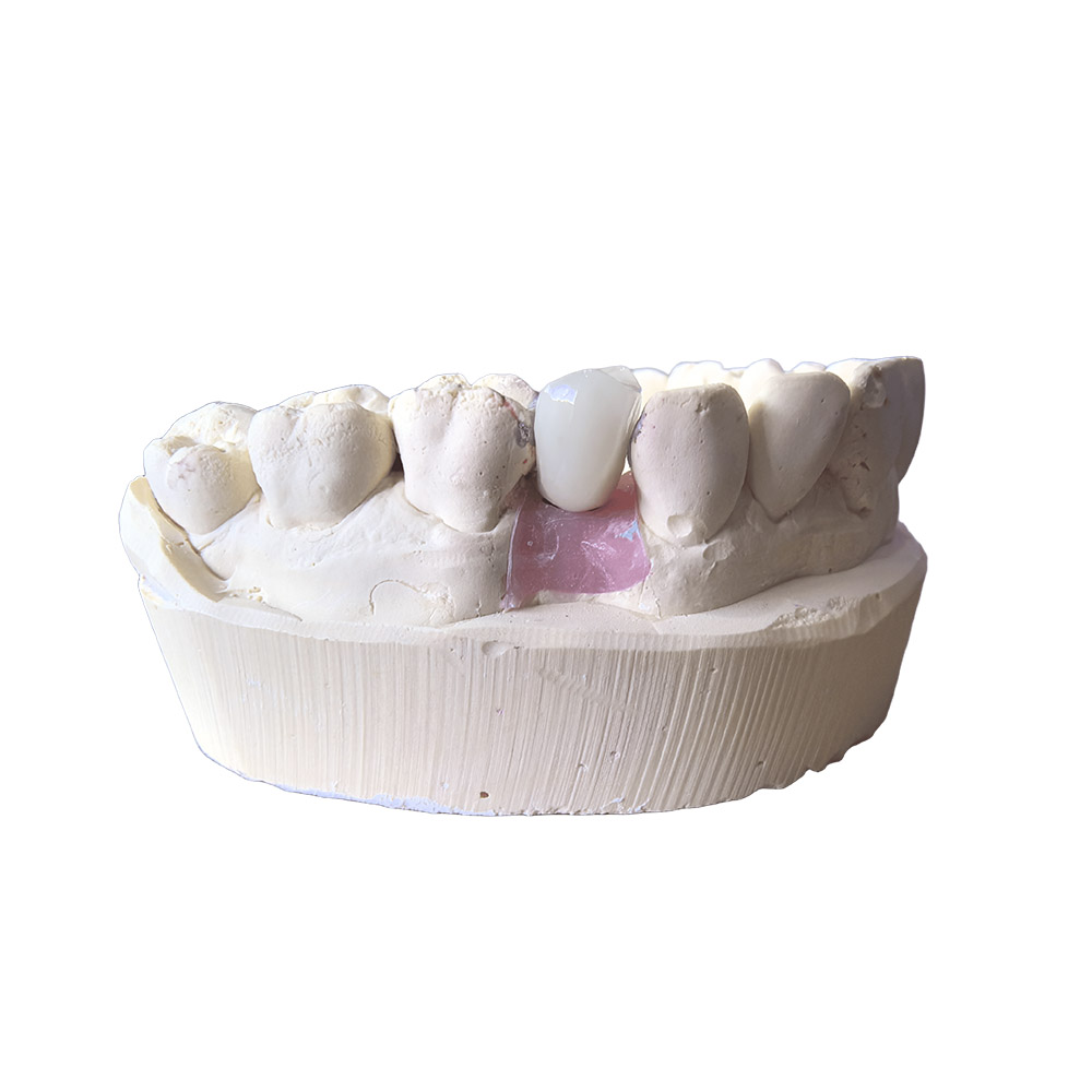 A1 Zirconia Crowns - case 2