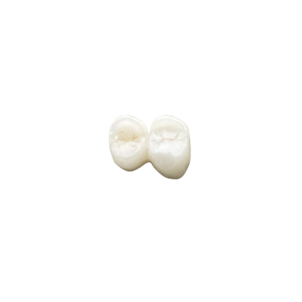 B1 Zirconia Crowns - case 2