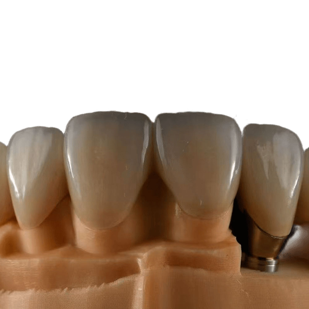 Ceramic Veneers - case 3