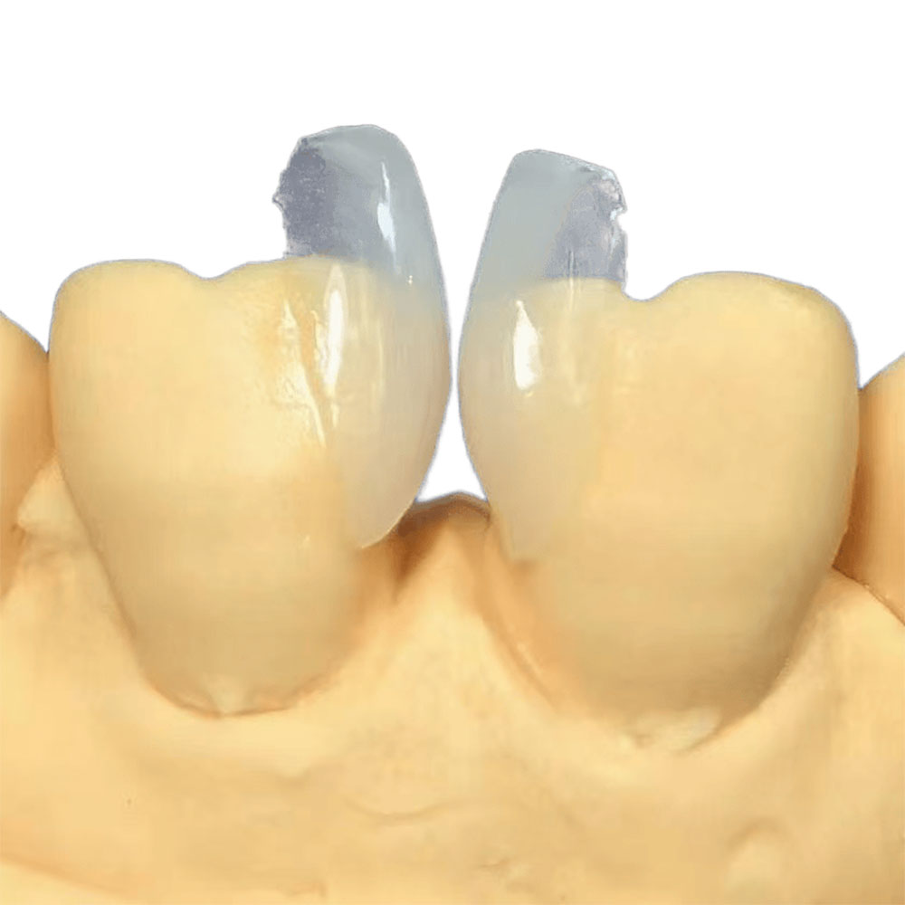 Clear Veneers - case 2
