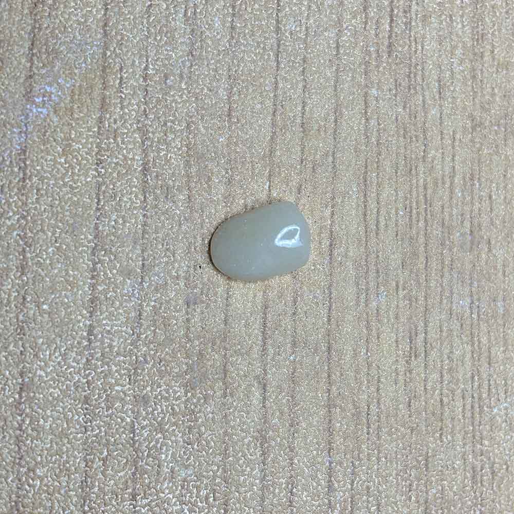 Composite Veneers