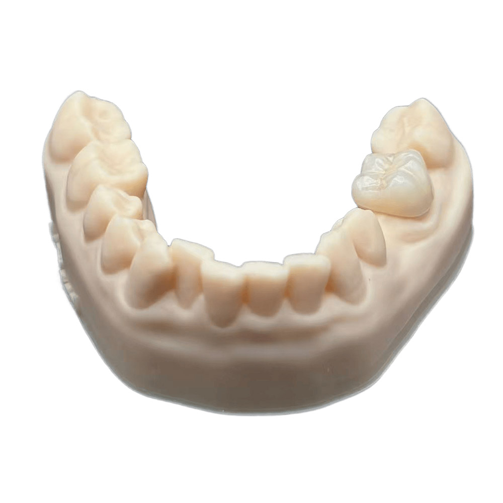 E.max Restorations - produced by Istar Dental Lab