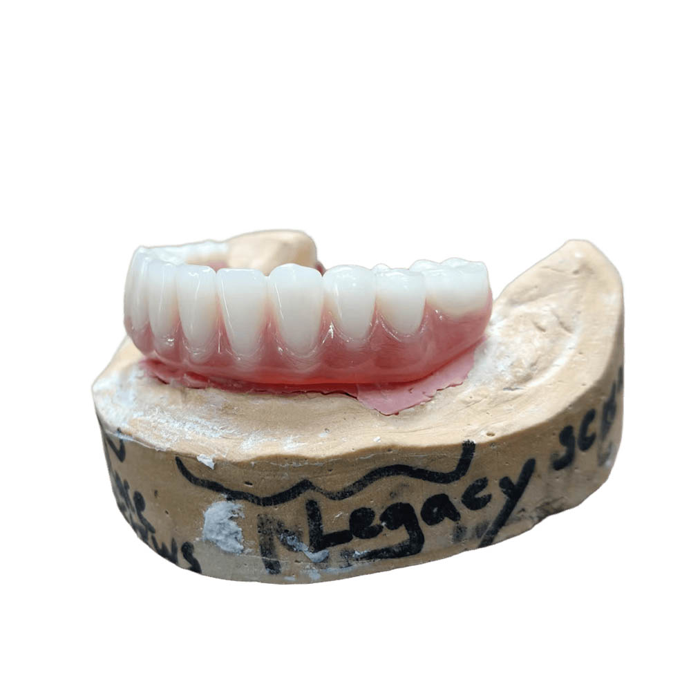 Fixed Permanent Implant Supported Dentures