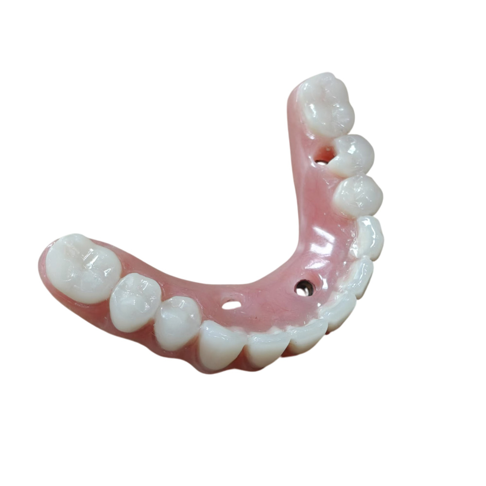 Fixed Permanent Implant Supported Dentures - case 3
