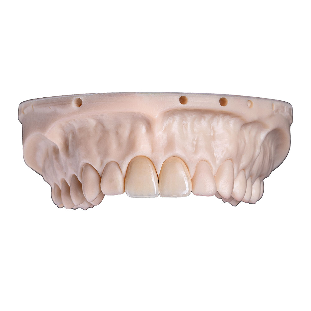 Front Anterior Teeth Veneers - case 2