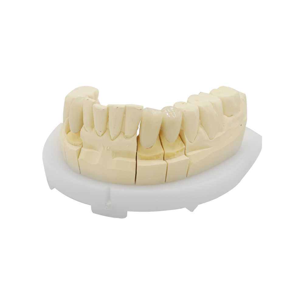 Full Contour Zirconia Crown and Bridge - case 3