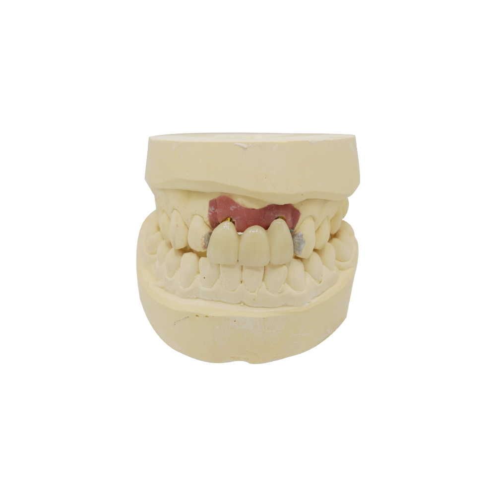 Lateral Incisor Implant - case 2