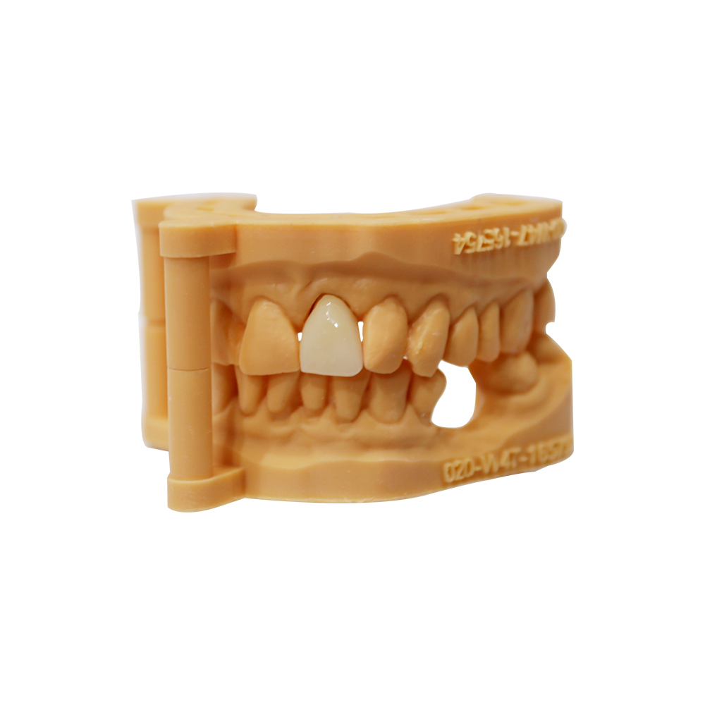 Layered Zirconia Crown - case 2