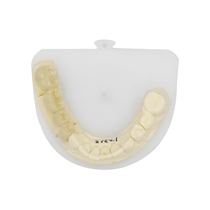 pfm bridge posterior
