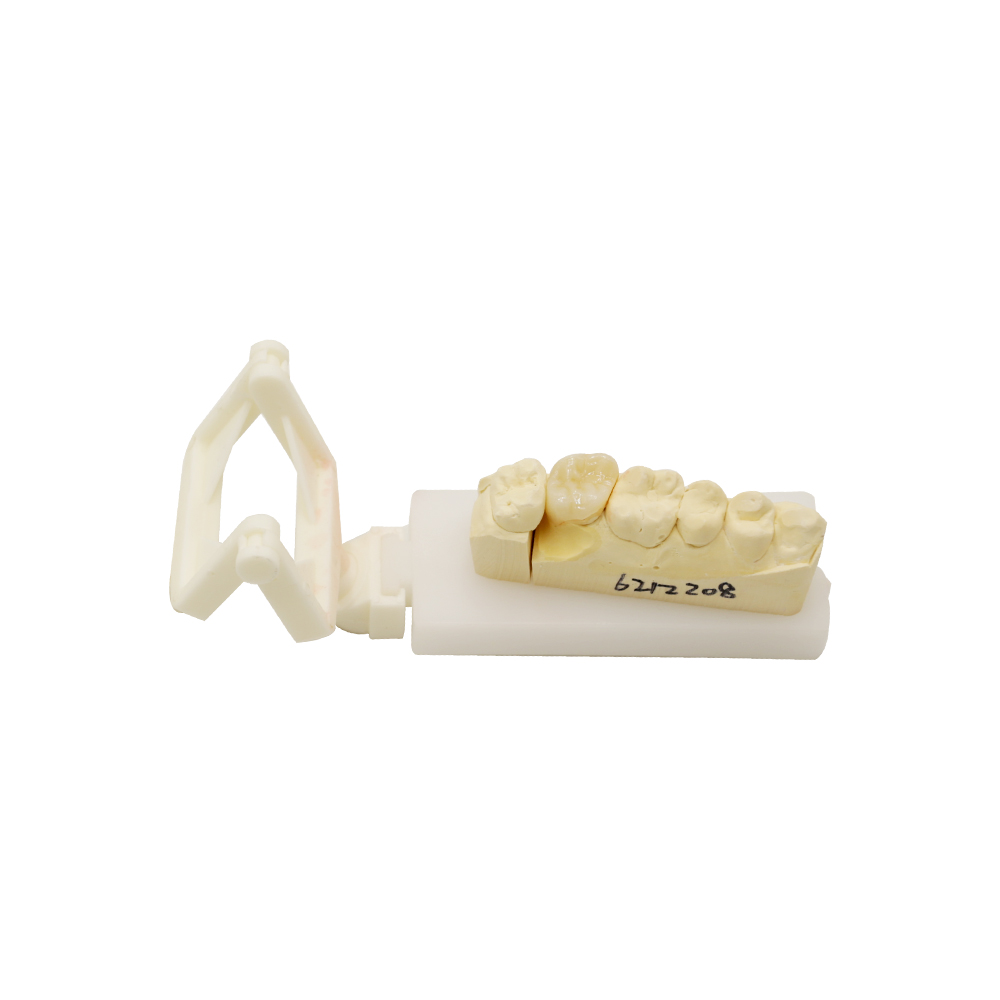 PFM Crown Molar