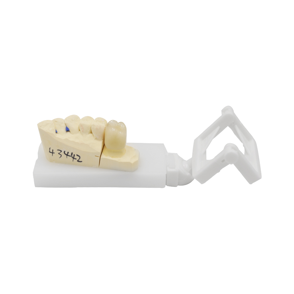 PFM Crown Molar - case 2