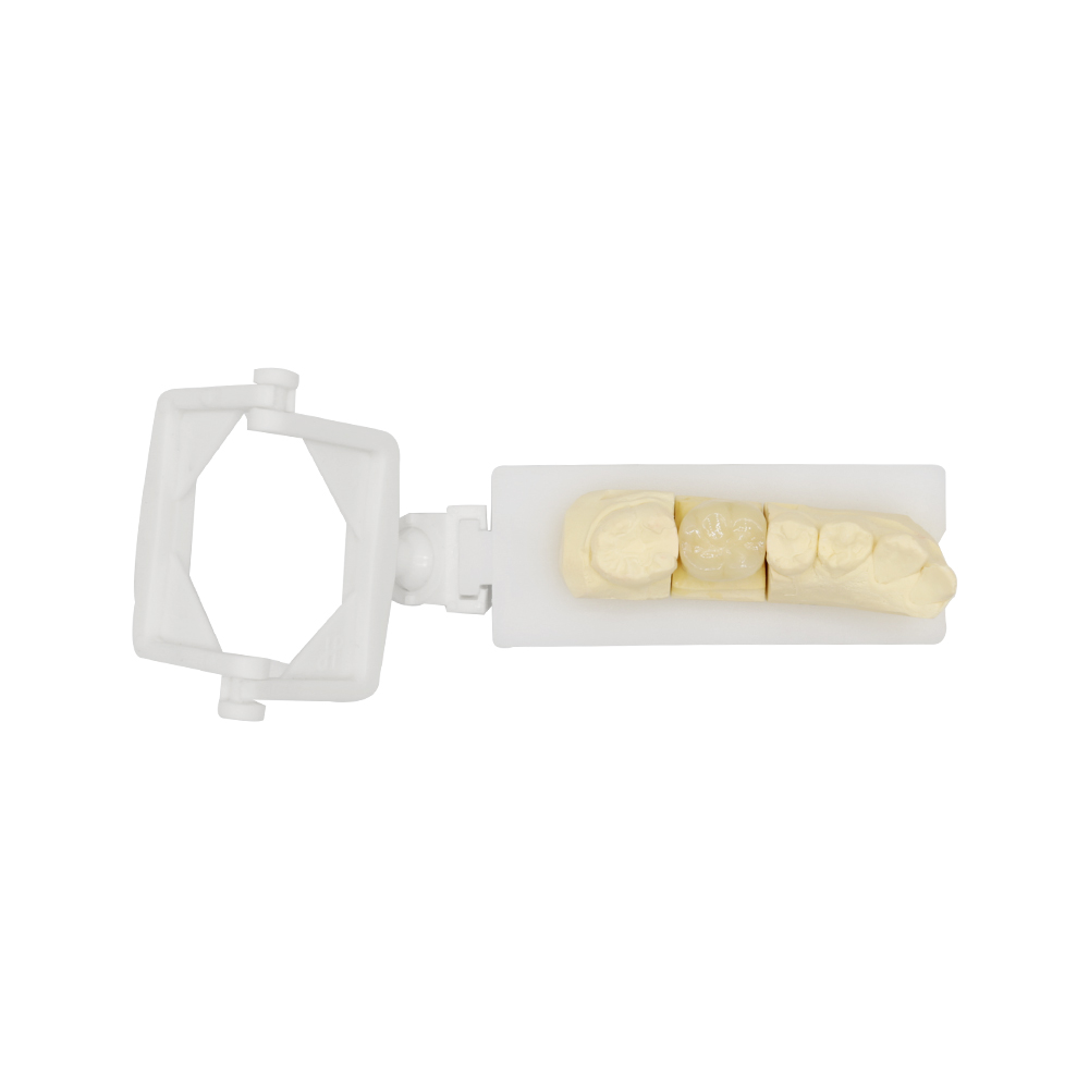 PFM Crown Molar - case 3