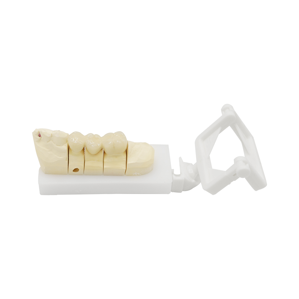 PFM Crown Posterior
