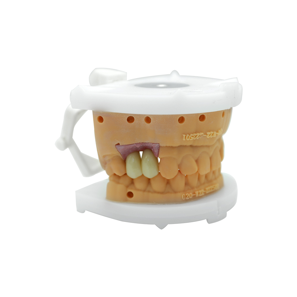 PFM Crown Premolar - case 2