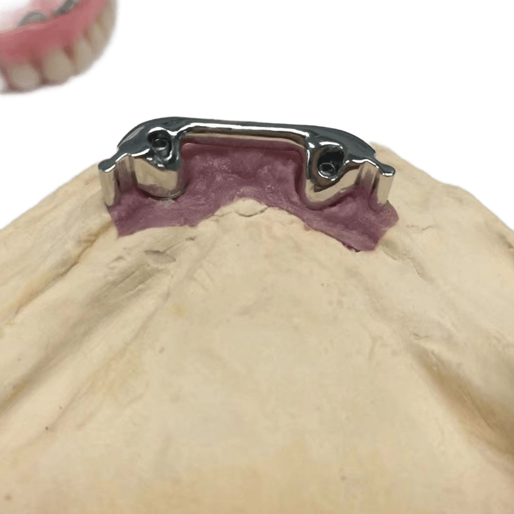 Precision Attachment Partial Denture - case 2