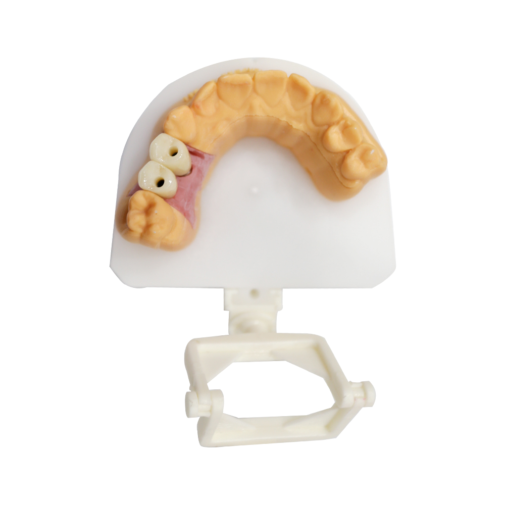 Screw Retained Implant Crown - case 2