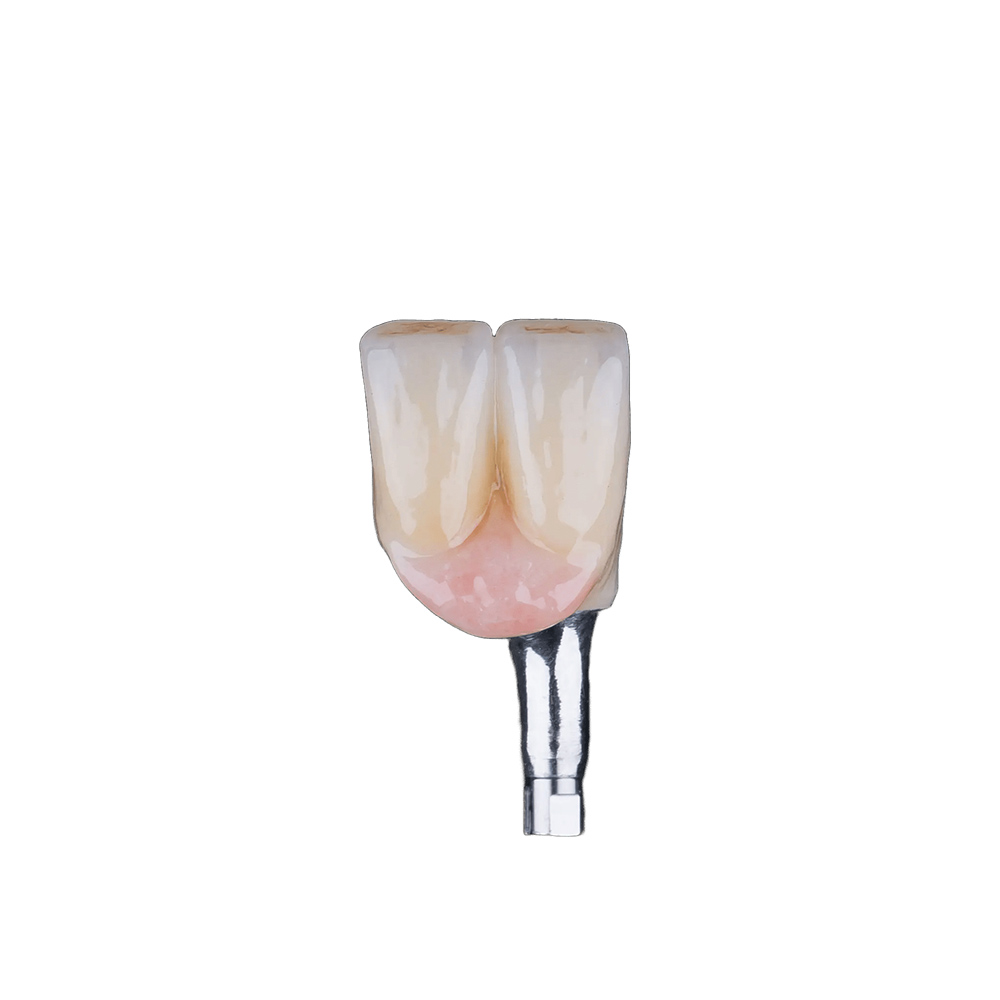 Two Teeth On One Implant - case 2