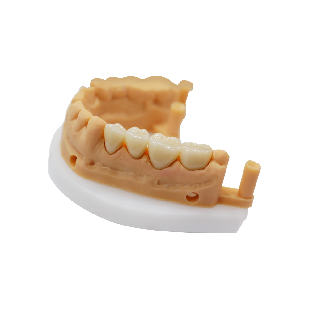 Zirconia Crown Molar - case 2