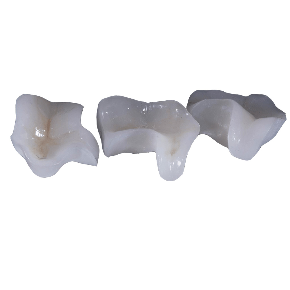 Zirconia Inlay - case 2